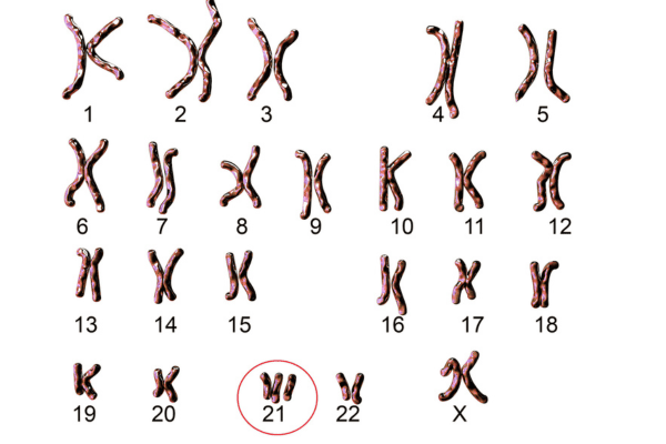 Trisomy 21 causes down syndrome