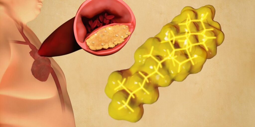 a man cause high cholesterol level in blood