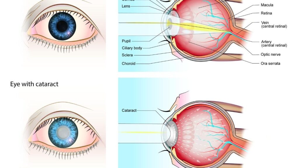 Eye anatomy comparison with cataract